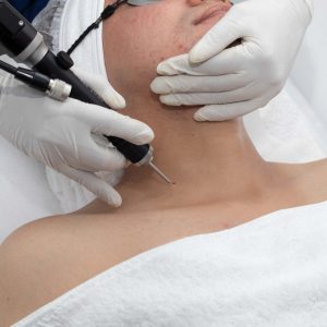 LASER PARA VERRUGAS Y ACROCORDONES - 2 UNIDADES