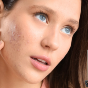 PACK DE SECUELAS DE ACNE